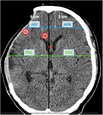 New perspectives on assessment and understanding of the patient with cranial bone defect: a morphometric and cerebral radiodensity assessment